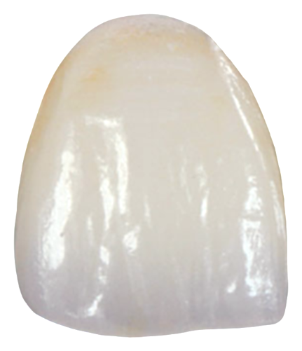 Couronne IPS e.max